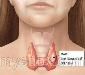Рак щитовидної залози