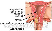 Рак шейки матки