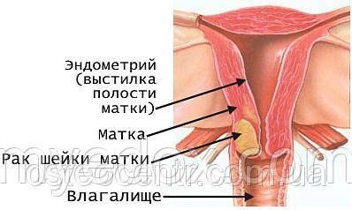 Рак шейки матки