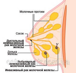 Рак молочної залози