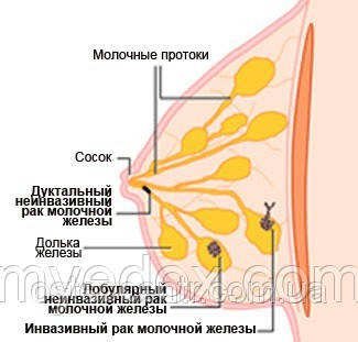 Рак молочної залози