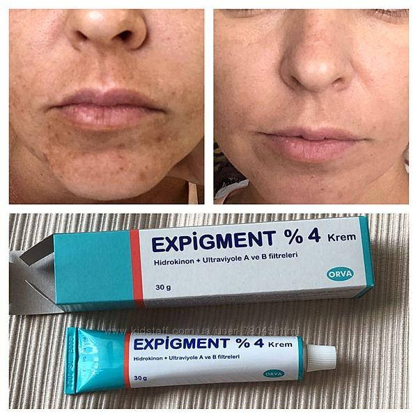 

Экспигмент Expigment отбеливающий крем от пигментных пятен 4%