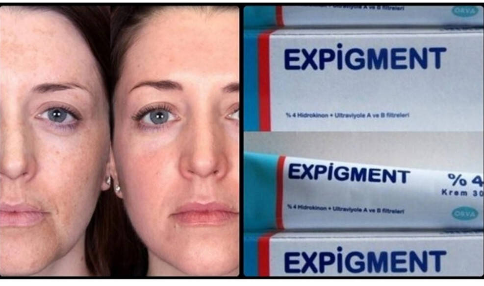 

Отбеливающий крем Экспигмент Expigment, 2%-4%, В наличии