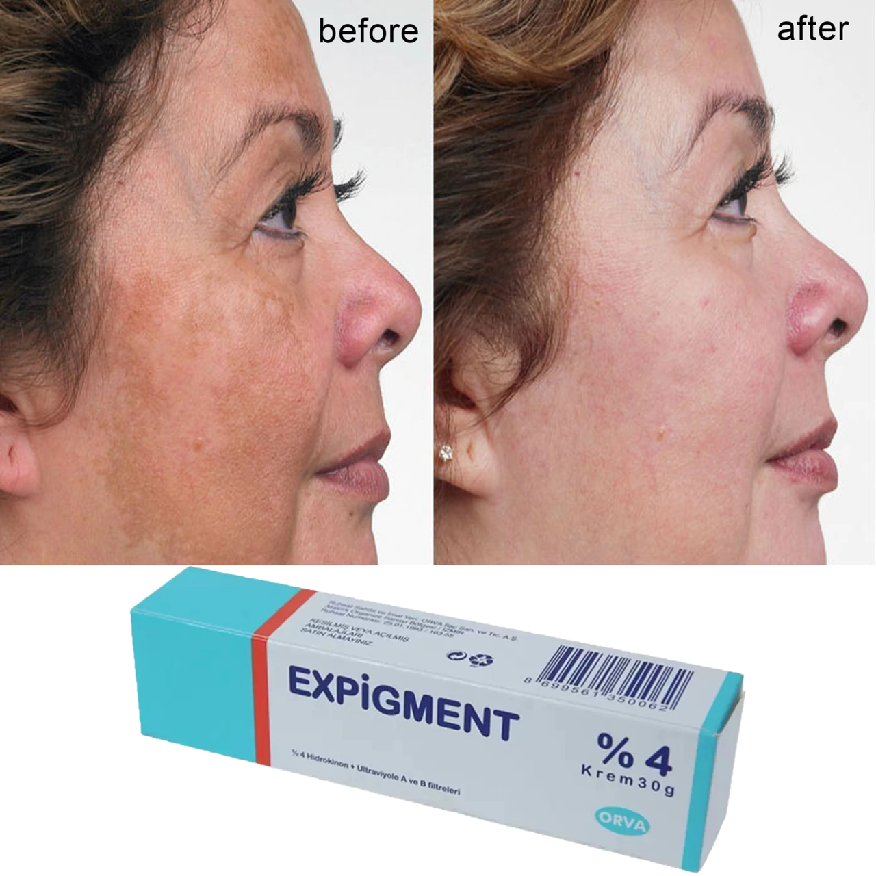 

Отбеливающий крем Экспигмент Expigment Оригинал!