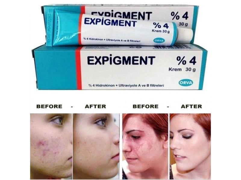 

Expigment гидрохинон экспигмент 4% крем | 30 грамм