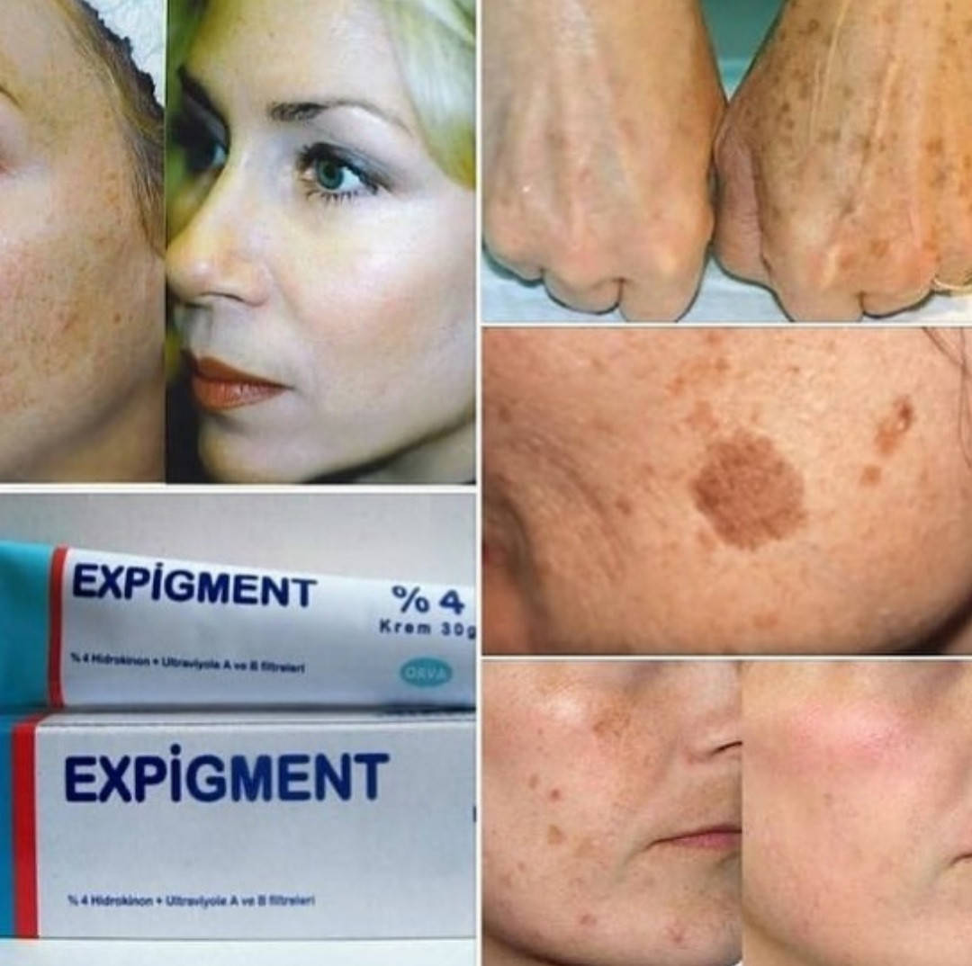 

Отбеливающий крем Экспигмент Expigment, 2%-4%, В наличии