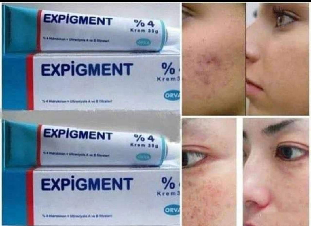 

Крем от пигментации,Expigment 4%,(Экспигмент)-отбеливающий крем 2%-4%