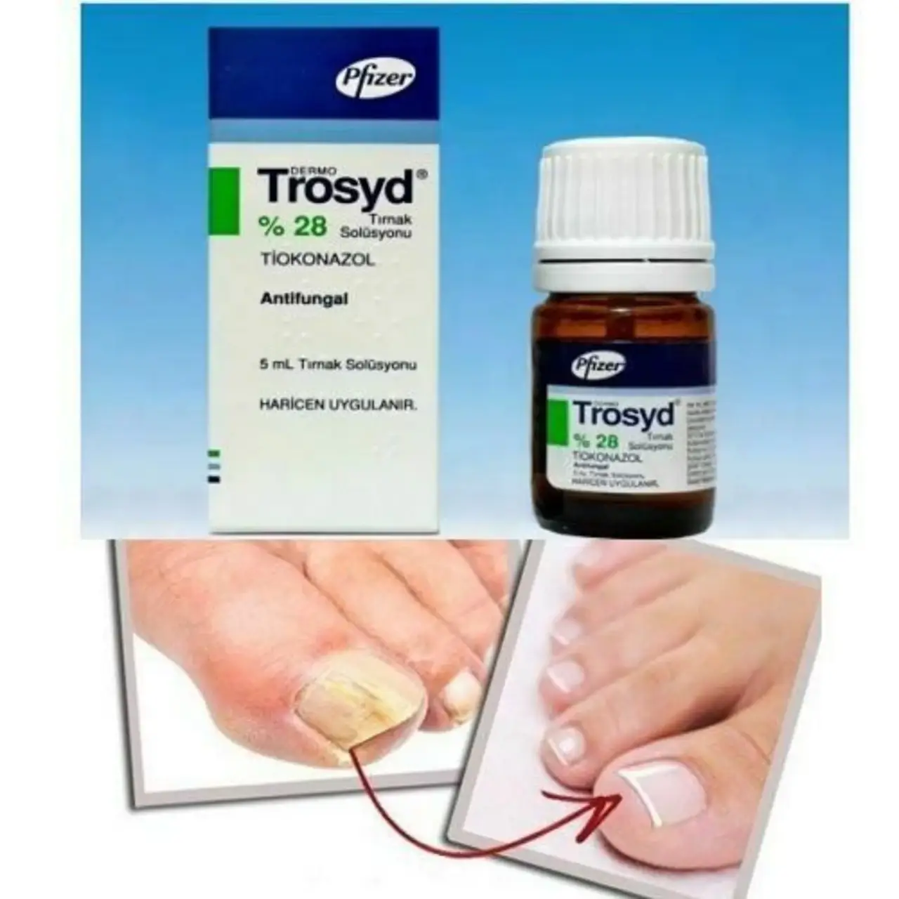 

Трозид 5 мл. Trosyd (Тиоконазол) Лак От Грибка Ногтей 28% - Оригинал.